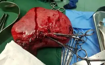 جراحی موفقیت‌آمیز برداشتن توده ۲ کیلویی در قم