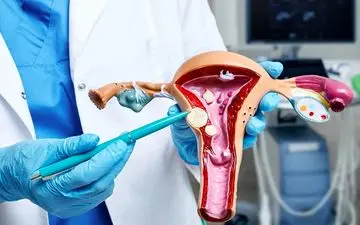 همه چیز درباره فیبروم رحم؛ علائم، خطرات و راه‌های درمان