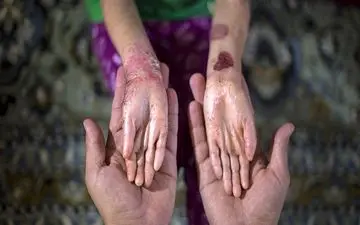 هیچ مشکلی در تأمین پانسمان بیماران «پروانه‌ای» وجود ندارد