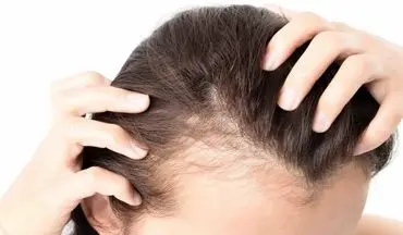 این مواد غذایی باعث ریزش مو میشوند!