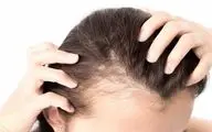 این مواد غذایی باعث ریزش مو میشوند!