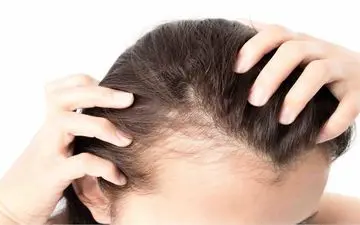 این مواد غذایی باعث ریزش مو میشوند!