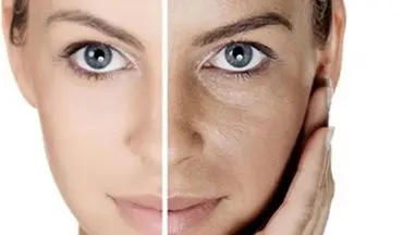۱۰ روش طبیعی برای رفع چربی پوست