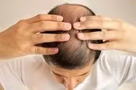این داروی ریزش مو باعث خودکشی افراد می‌شود