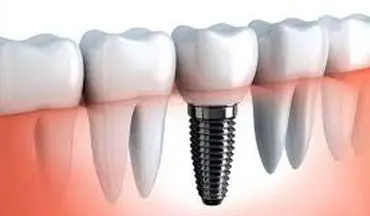 ایمپلنت دندان چه عوارضی دارد؟