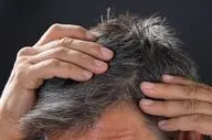 کمبود این ویتامین مقصر خشکی پوست و شوره سر شماست