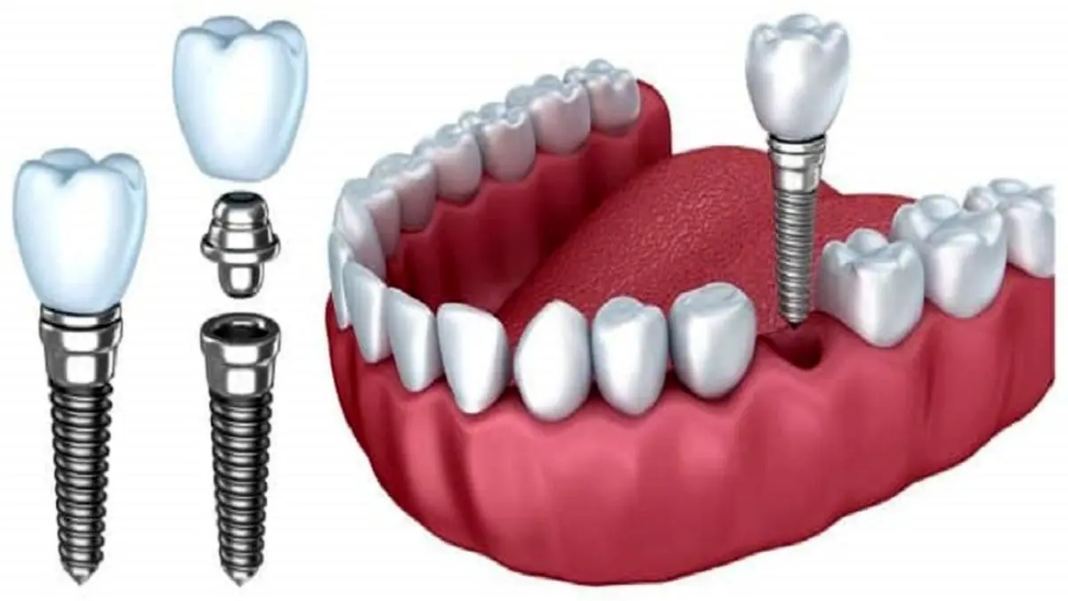 دلایل انتخاب ایمپلنت دندان برای بازسازی لبخند