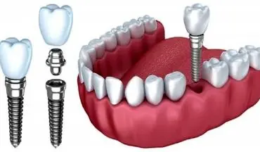 دلایل انتخاب ایمپلنت دندان برای بازسازی لبخند