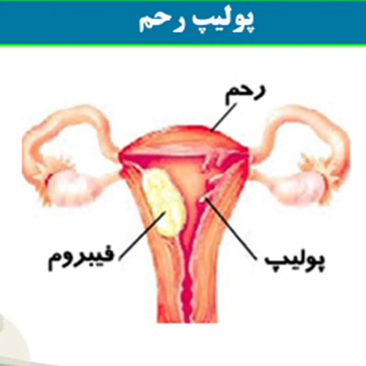 پولیپ رحم چیست؟علائم پولیپ رحم چیست؟