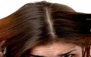  تاثیر روغن های گیاهی بر درمان شوره سر