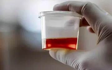 علت تغییر رنگ ادرار به قرمز یا صورتی