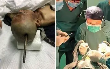 زنده ماندن مردی که میلگرد در جمجمه اش فرو رفت! +عکس های باورنکردنی