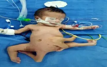  نوزاد عجیب الخلقه به دنیا آمد! / عکس های + 16