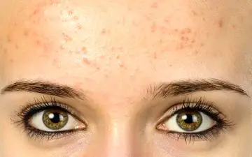 جوش های ریز پیشانی: دلایل بروز و راهکارهای خانگی برای از بین بردن آن ها
