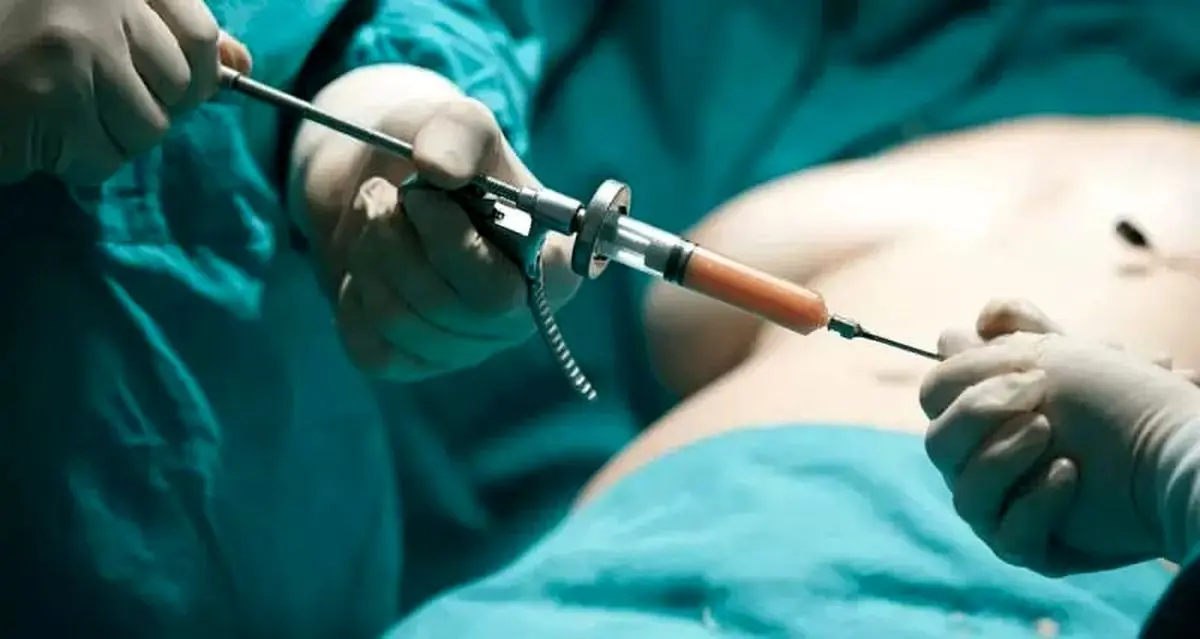 BBL، پرریسک‌ترین و پشیمان‌کننده‌ترین جراحی ۲۰۲۵؛ موج پشیمانی سلبریتی‌ها و زنان از لیفت باسن برزیلی!