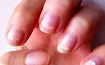 کم خونی را با این روش خیلی راحت تشخیص بدهید