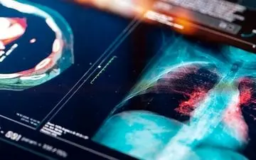 تشخیص سرطان ریه با یک آزمایش ساده روی ناخن‌ها