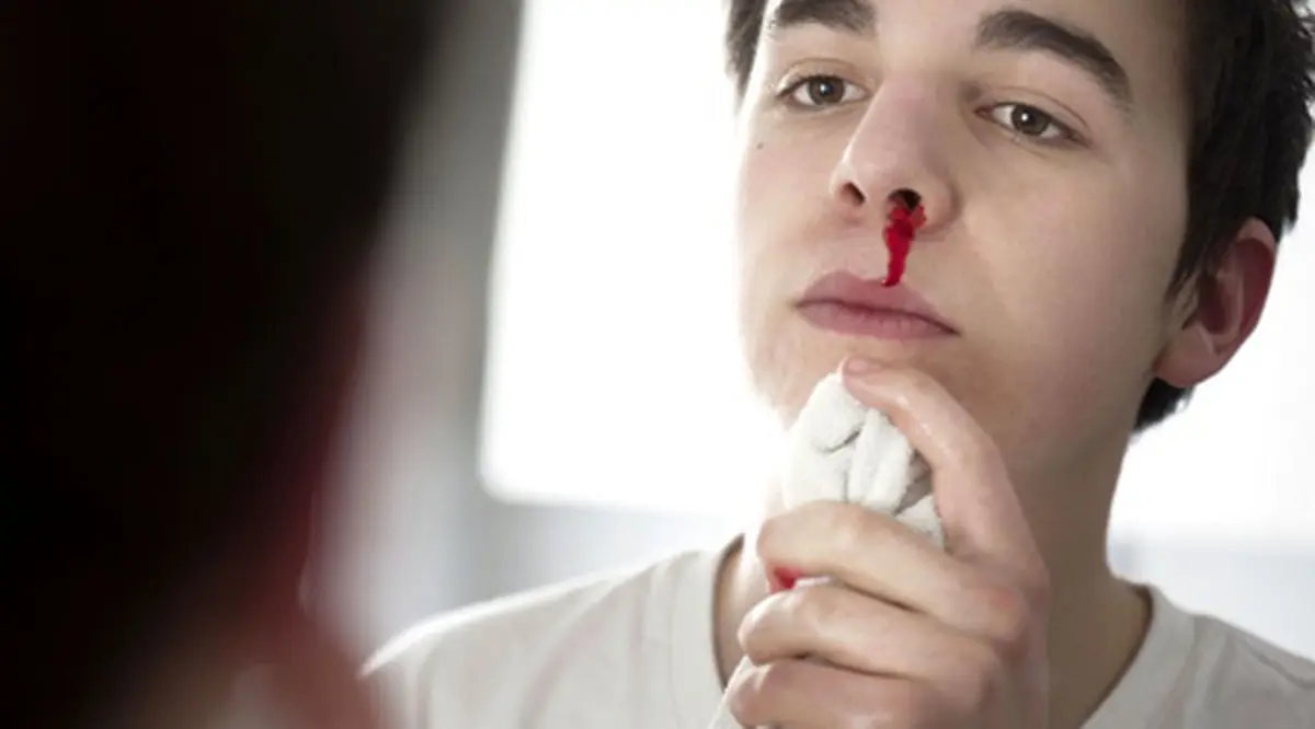 
چند راه‌های برخورد با خونریزی بینی