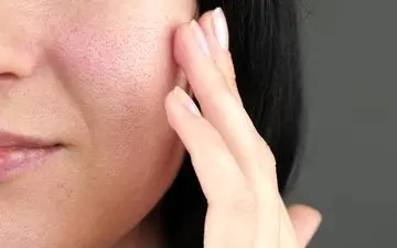 چگونه از شر منافذ باز پوست خلاص شویم؟