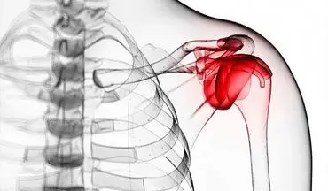 شانه یخ‌زده چیست؟+ علل و روند ایجاد بیماری