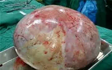 توده چهار و نیم کیلویی از شکم یک بانوی 18 ساله در میناب هرمزگان خارج شد