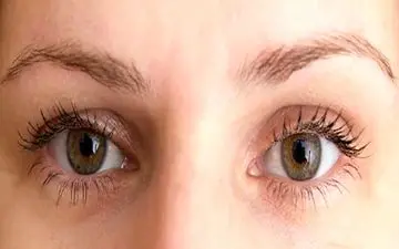 روش های درمان افتادگی پلک