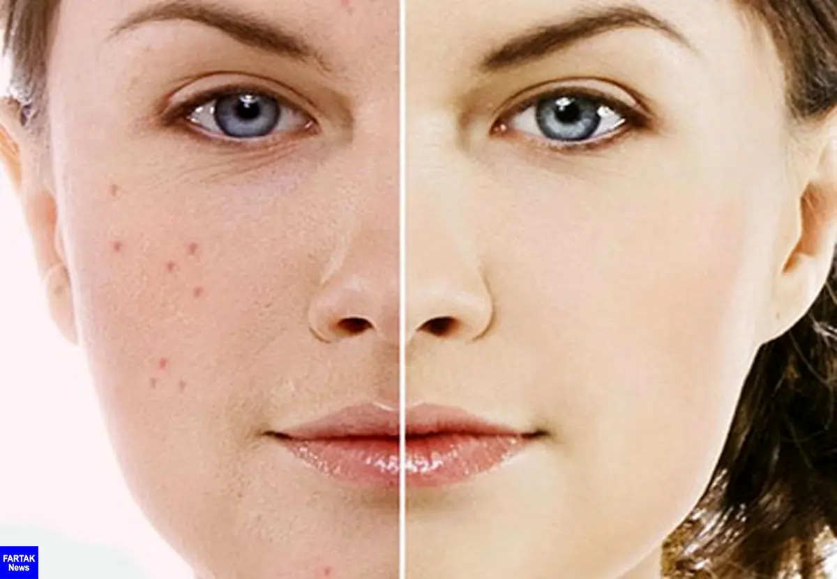 رابطه پوست صاف و دوران قاعدگی زنان| چند راهکار برای داشتن صورت صاف و بدون جوش