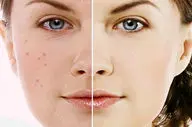 رابطه پوست صاف و دوران قاعدگی زنان| چند راهکار برای داشتن صورت صاف و بدون جوش