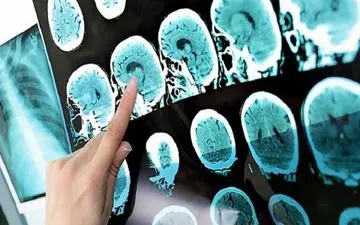 تشخیص زود هنگام بیماری ام اس با این نشانه ها