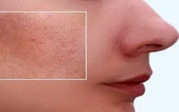 چطوری منافذ باز پوست خود را ببندیم؟