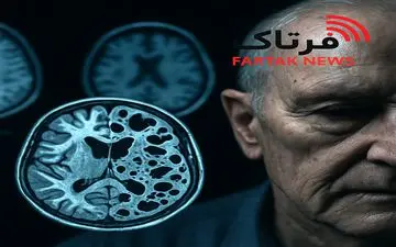 بیماری کروتزفلد-یاکوب چیست و چرا این‌قدر خطرناک است؟