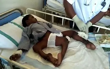 پسری عجیب الخلقه با ۳ پا 