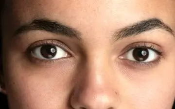 کمبود چه ویتامینی باعث سیاهی دور چشم می شود؟

