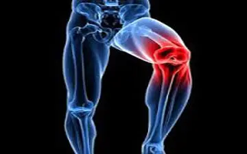 داروی درمان قطعی آرتروز چیست؟!