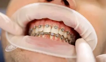 آیا این موارد در مورد ارتودنسی صحت دارد؟