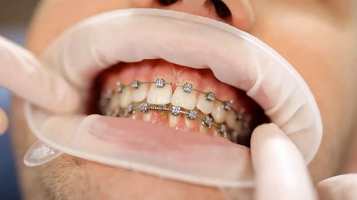 آیا این موارد در مورد ارتودنسی صحت دارد؟