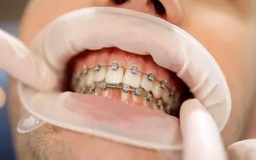 آیا این موارد در مورد ارتودنسی صحت دارد؟