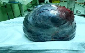 عکس عجیب / توده 6 کیلویی از شکم خانم اردبیلی خارج شد