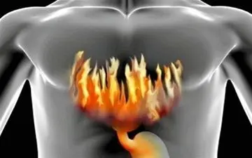 ریفلاکس معده، علل و درمان آن 