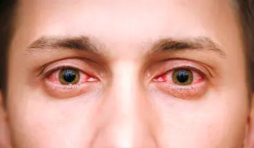 درمان تورم و قرمزی چشم را با گیاهان دارویی