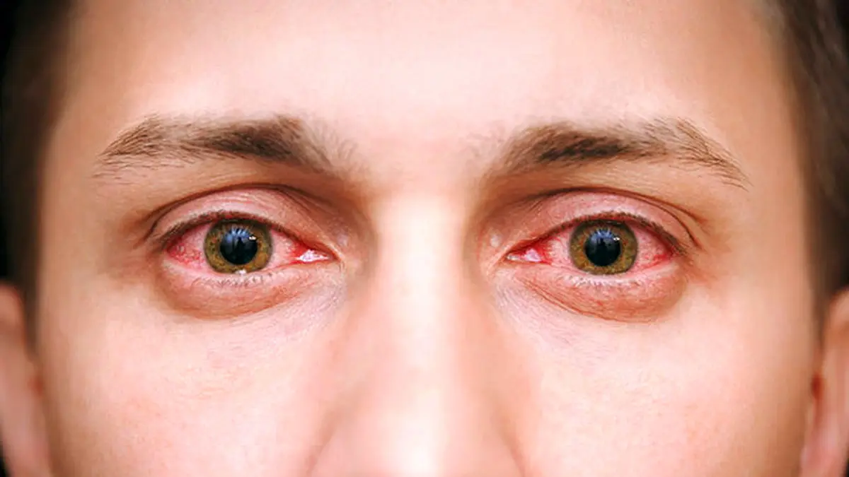 درمان تورم و قرمزی چشم را با گیاهان دارویی