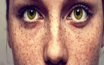 تشخیص کک‌و‌مک، لکه‌های آفتابی و خال: نکات کلیدی برای سلامت پوست