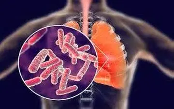 کاهش زمان تشخیص بیماری سل