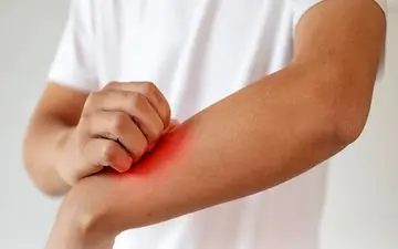 اگزما چیست؟ همه چیز درباره این بیماری پوستی شایع (فیلم)