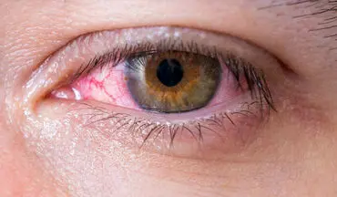 شایع ترین علت های قرمزی چشم