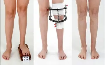 آیا جراحی افزایش قد واقعیت دارد؟