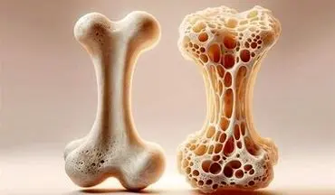 با این ماده معدنی مانع پوکی استخوان شوید