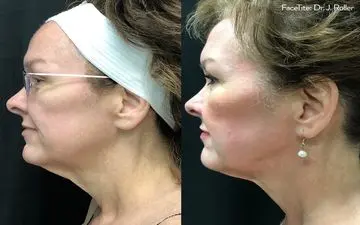 چگونه با فیس تایت زیباتر شویم؟نکات مهم درباره این روش زیبایی
