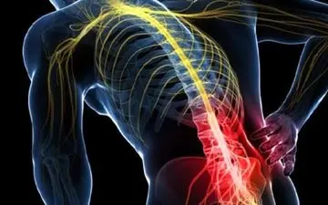 درد سیاتیک چیست ؟ | علت ایجاد درد سیاتیک و راهکار های درمانی
