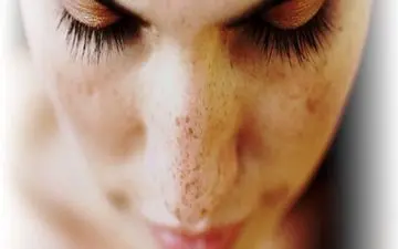 شایع‌ ترین دلیل بروز لک پوستی